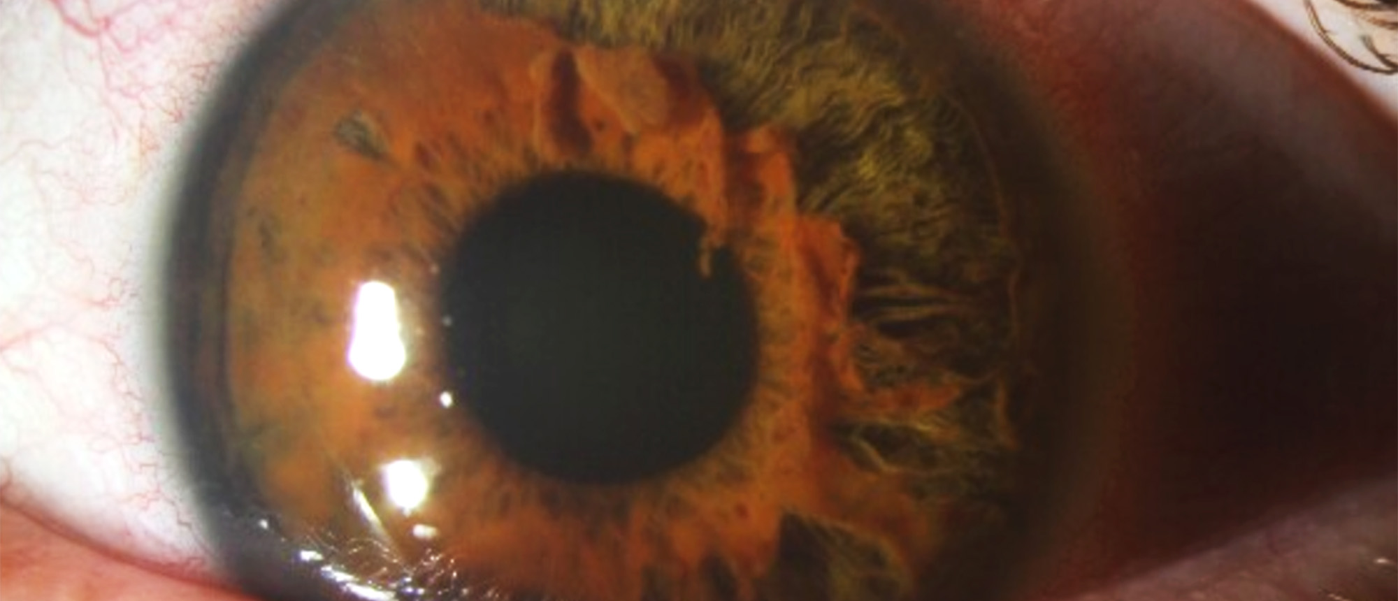 Iridoschisis