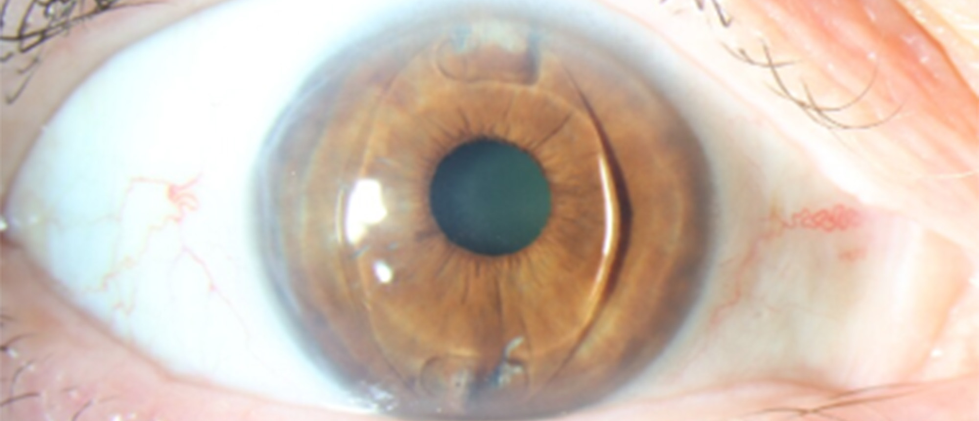 Dislocated Intraocular Lens