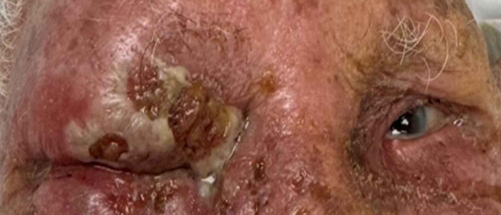 Periorbital Necrotizing Fasciitis