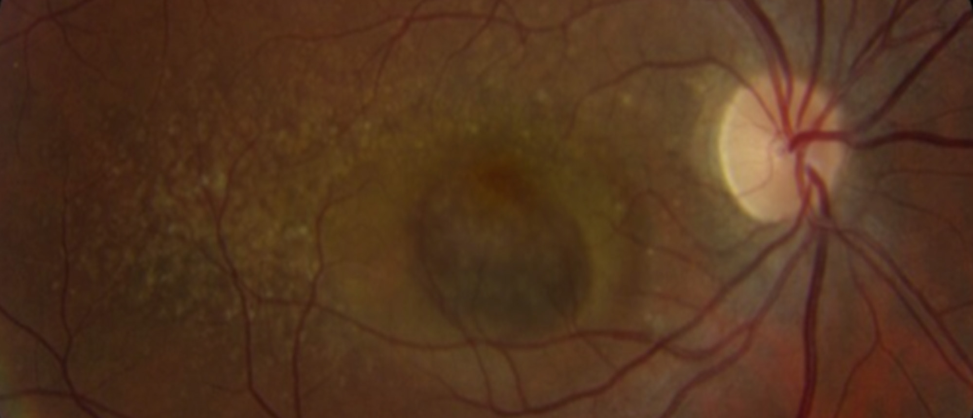 Polypoidal Choroidal Vasculopathy