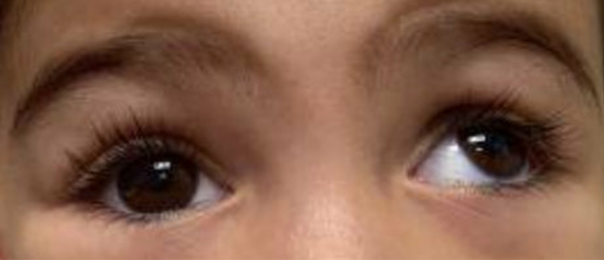 Brown Syndrome 