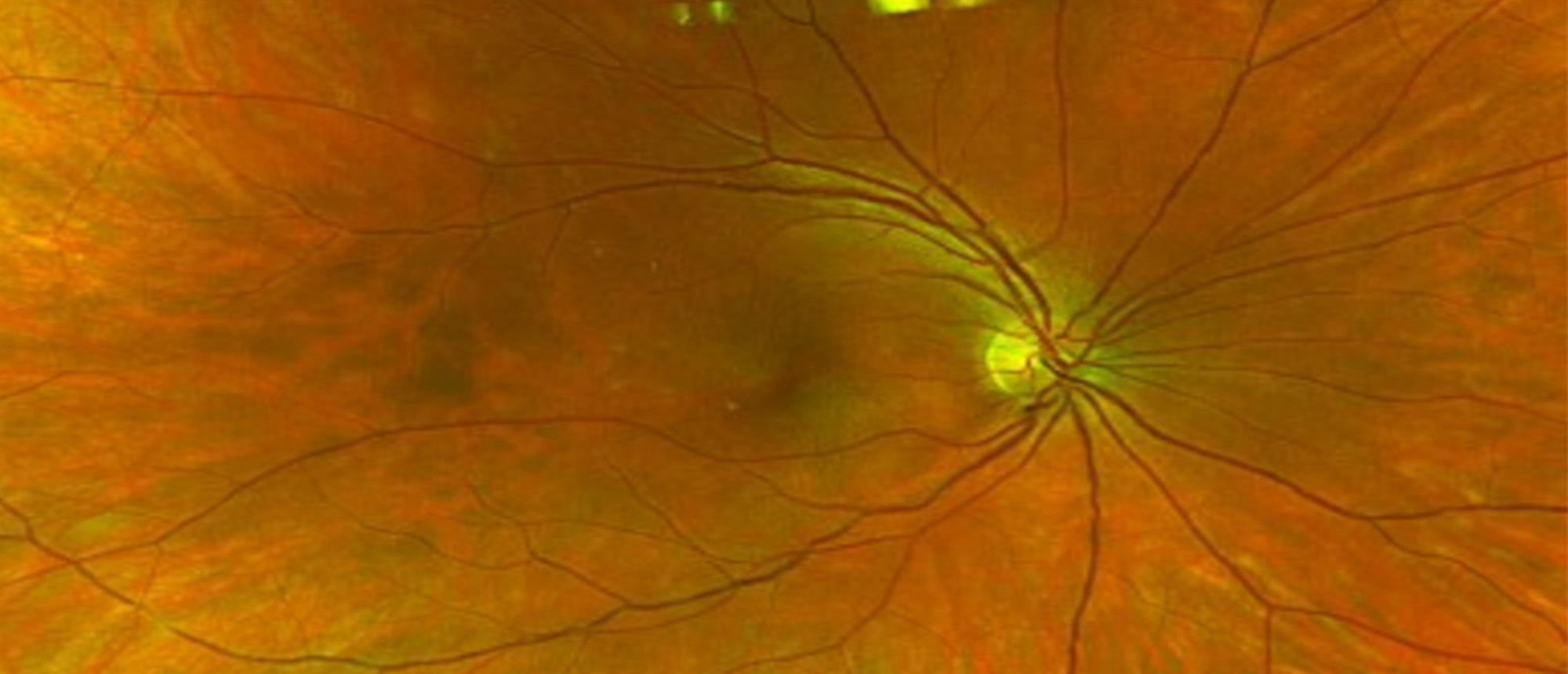 Birdshot Chorioretinopathy 