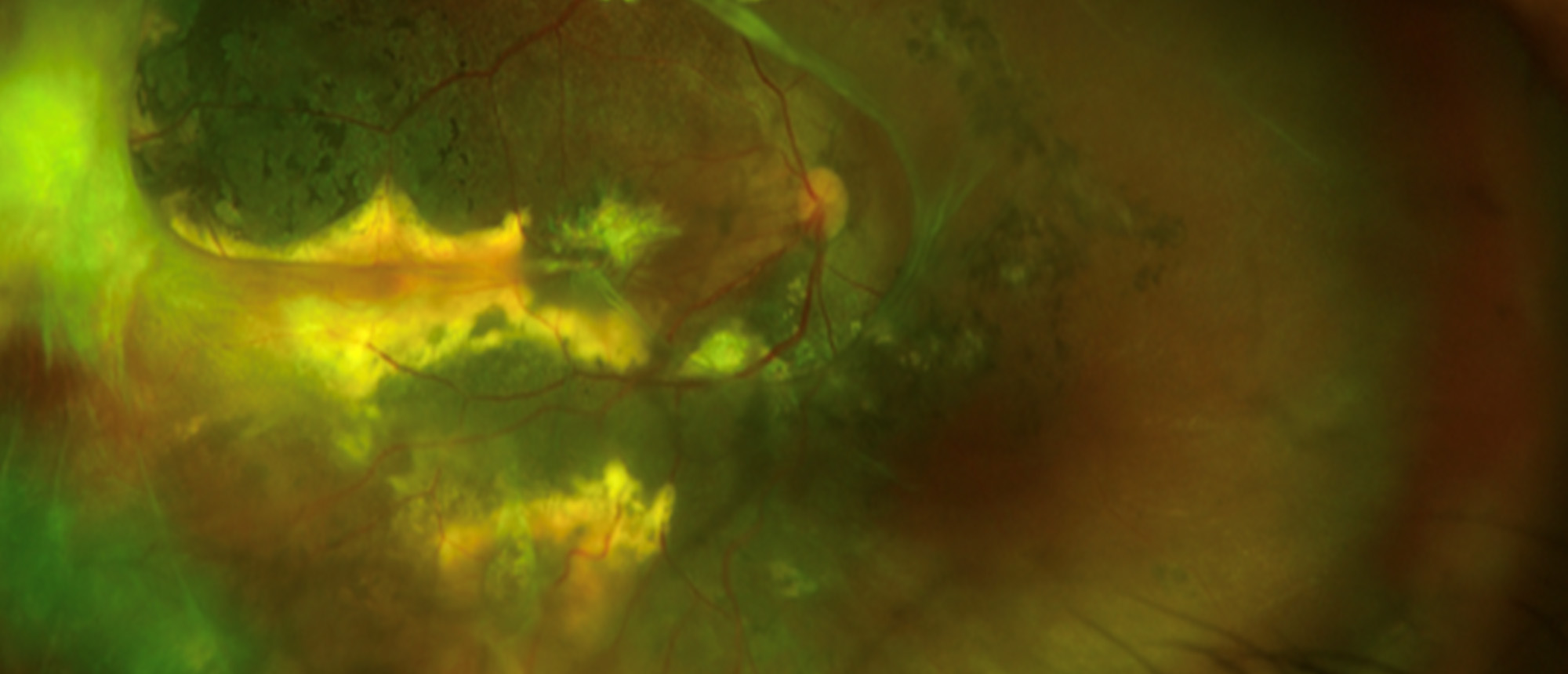 EYS-Associated Retinitis Pigmentosa with Coats-Like Response