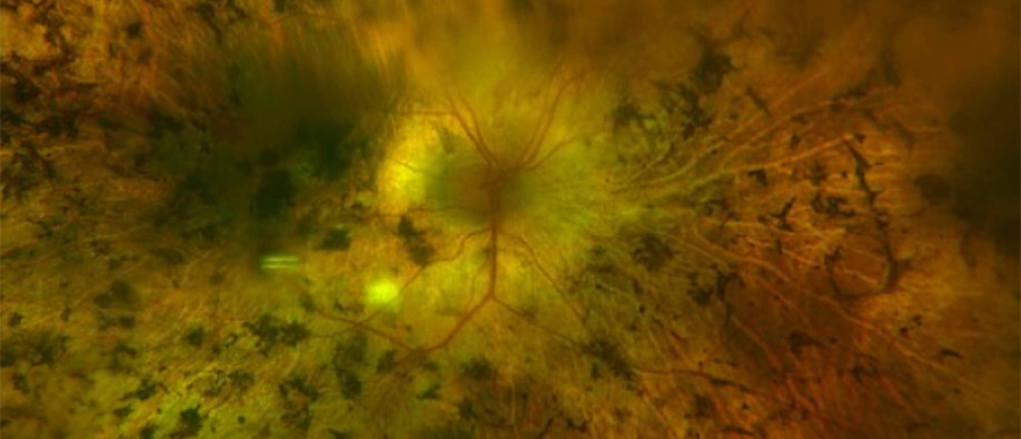 Abetalipoproteinemia 