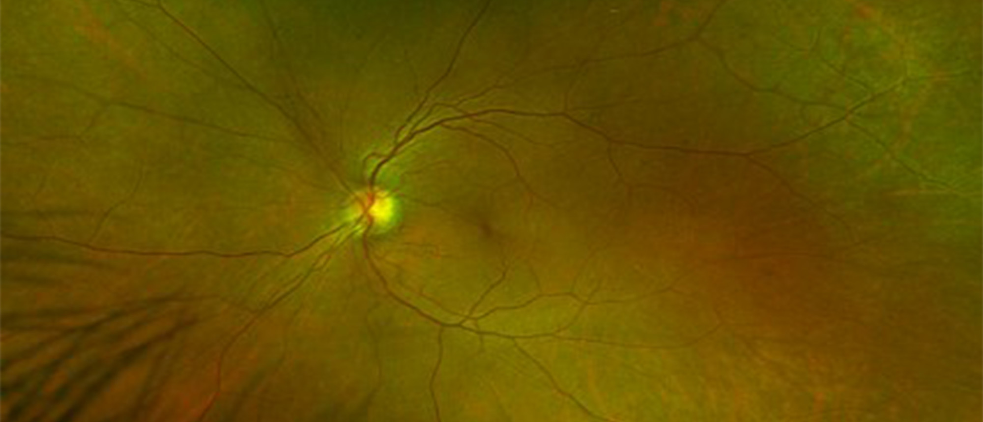 Oxazolidinone Toxic Optic Neuropathy