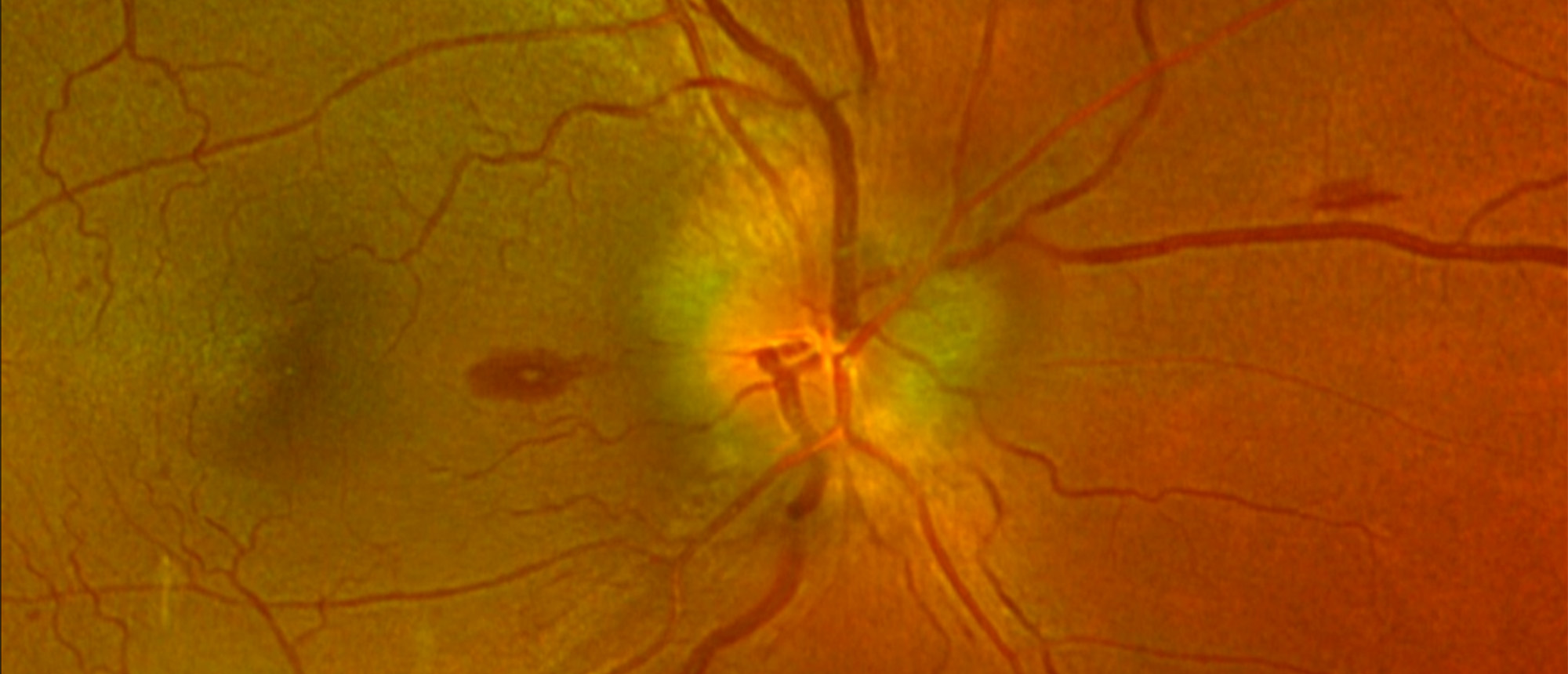 MOGAD Optic Neuritis with Atypical Presentation of Roth Spots