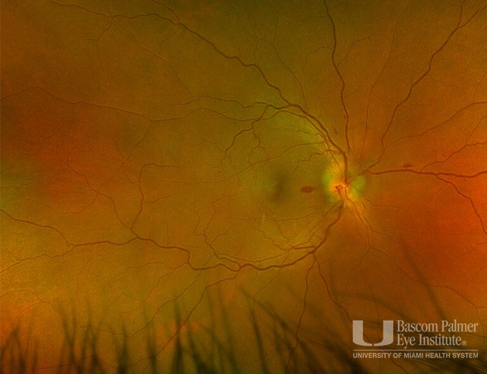 Fundus Image 1