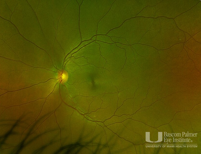 fundus Image 2