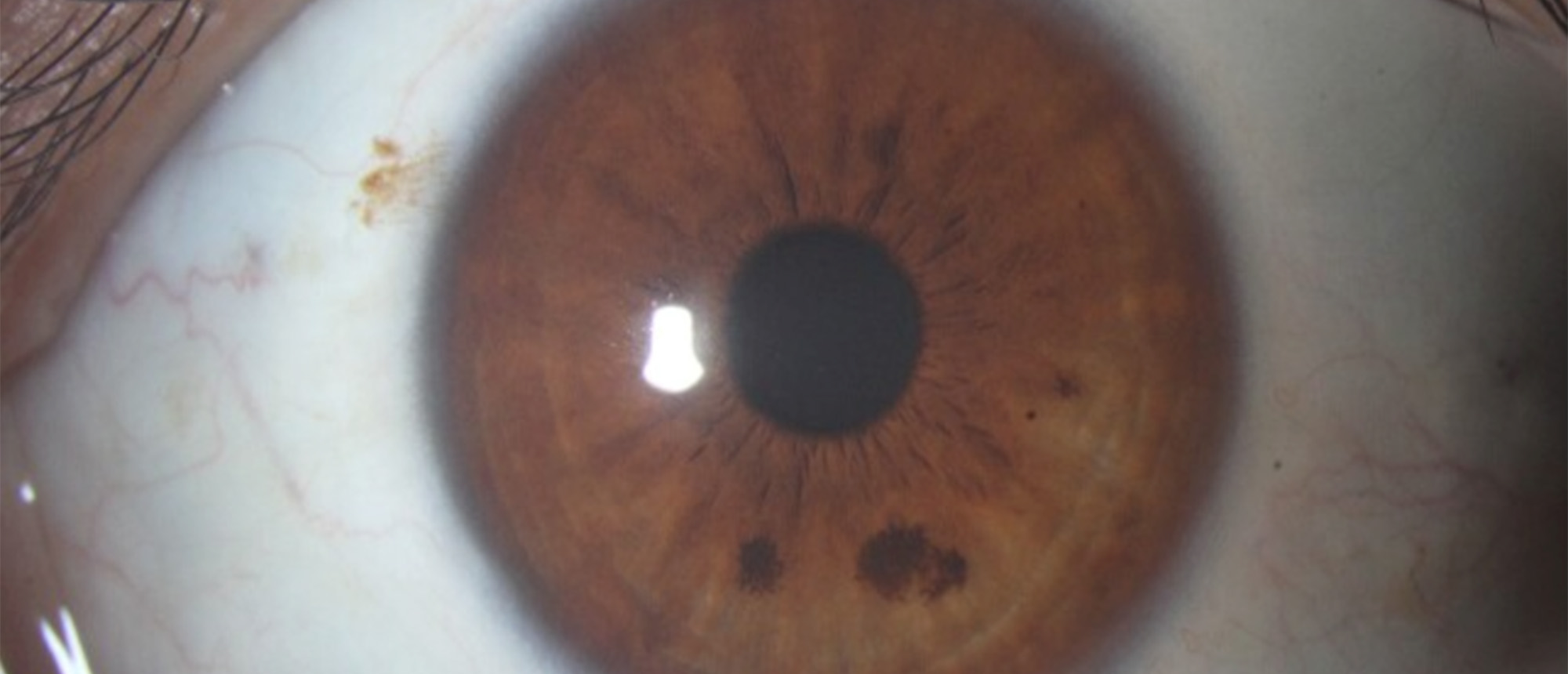Congenital Horner Syndrome 
