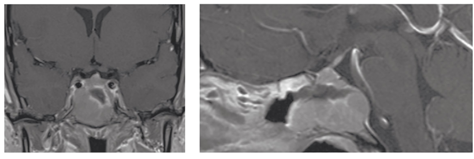 Cranial Nerve 6 Palsy from Metastatic Cholangiocarcinoma