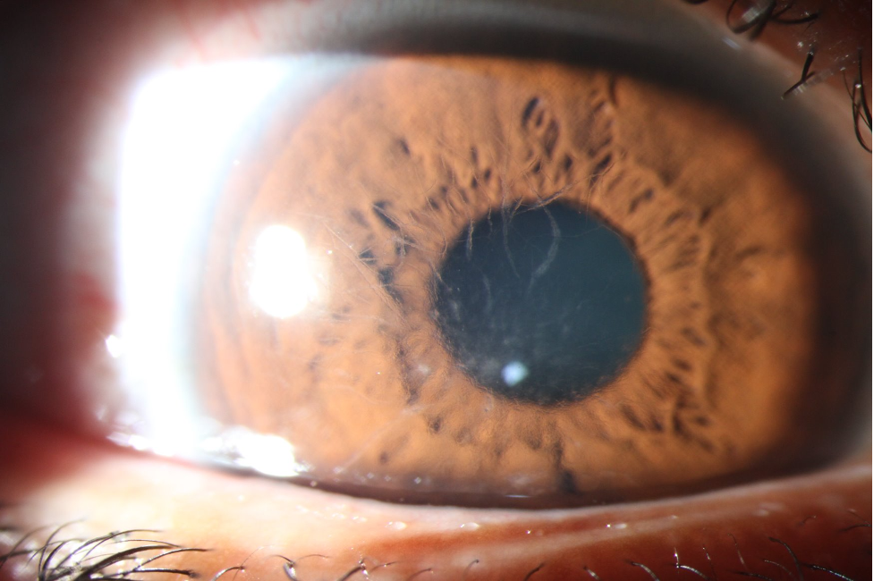 Lattice Corneal Dystrophy