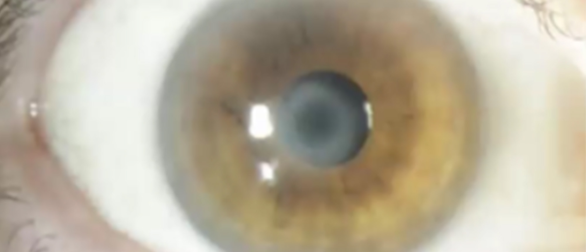 Corneal Haze After KAMRA Corneal Inlay Implantation