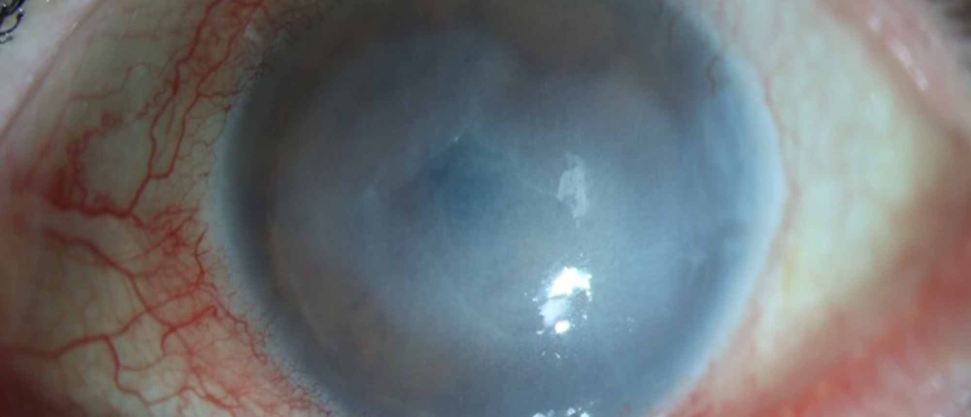 Acanthamoeba Keratitis 