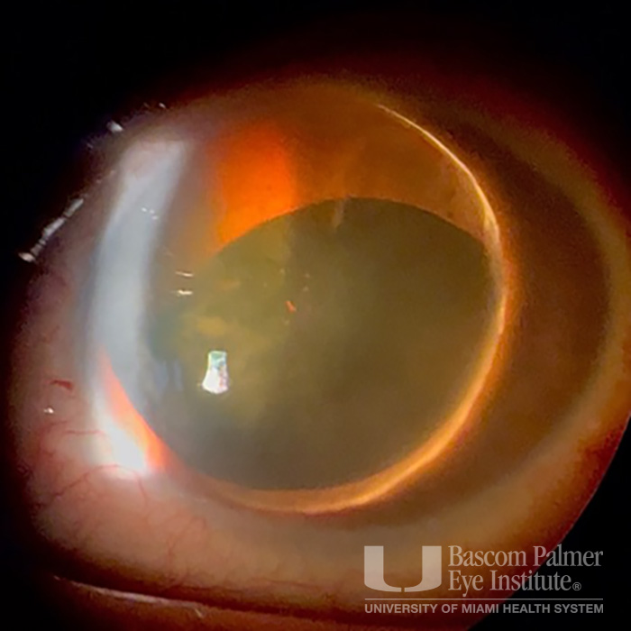 Anterior Lens Dislocation