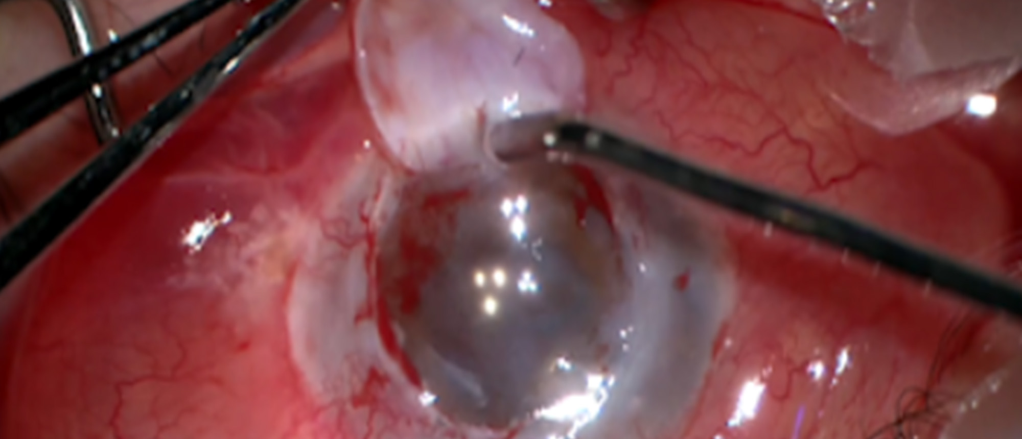Acanthamoeba Keratitis 
