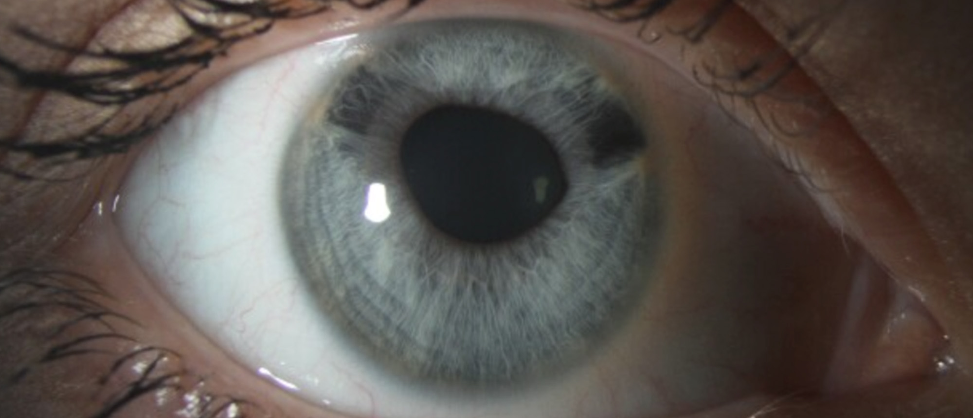 Iridocorneal Endothelial (ICE) Syndrome, with Secondary Angle Closure Glaucoma