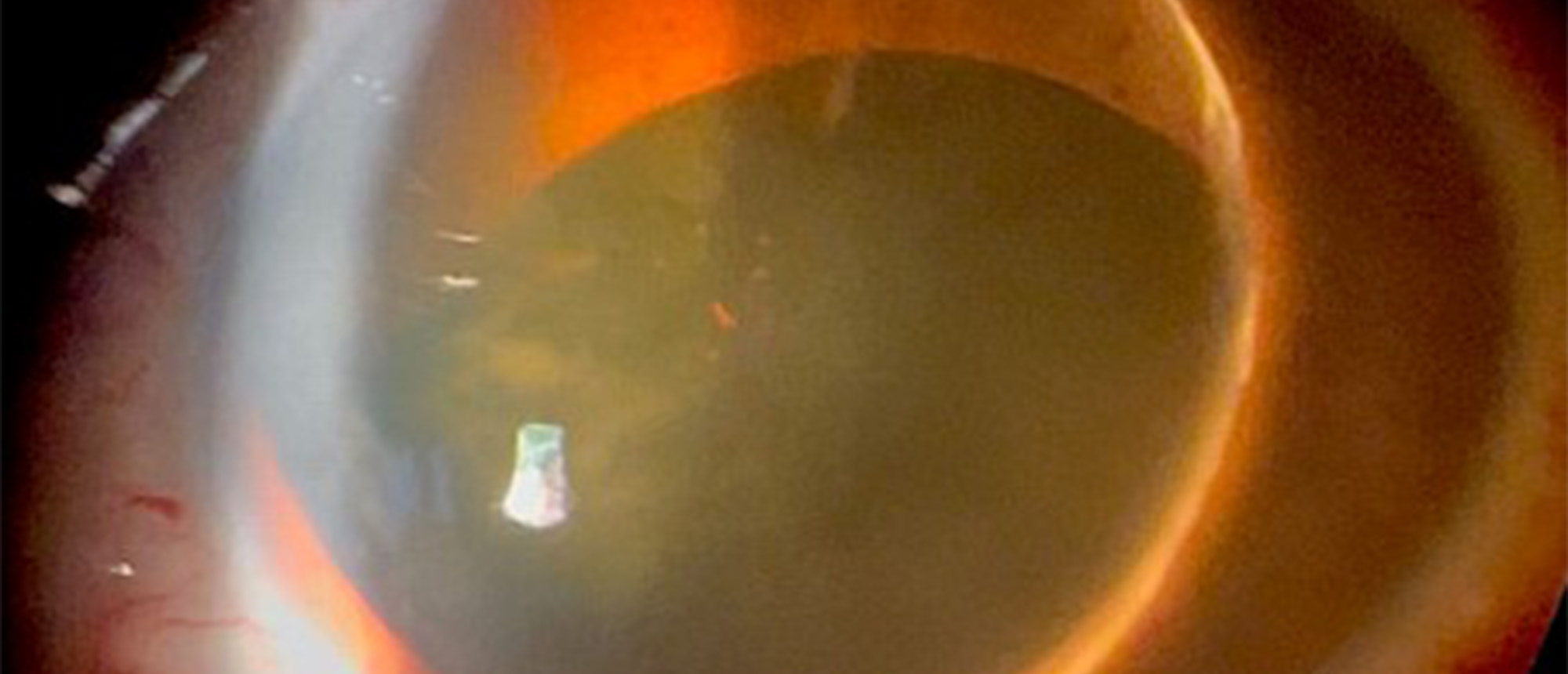 Traumatic Anterior Crystalline Lens Dislocation with Pupillary Block