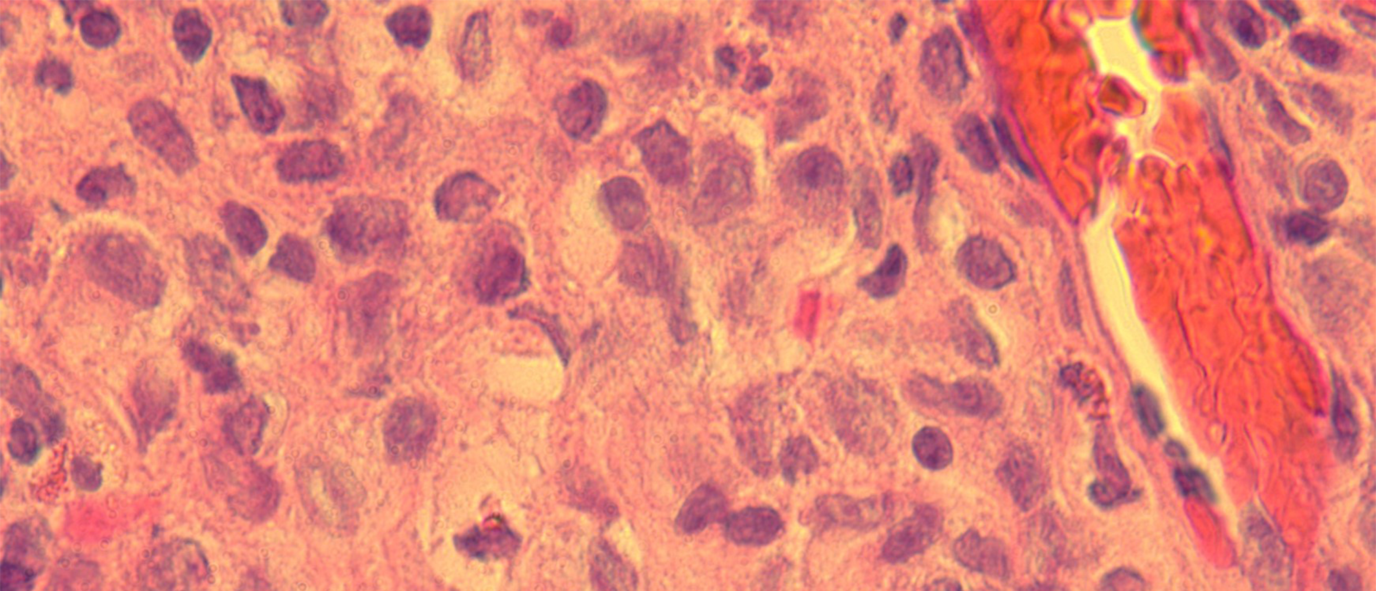 Langerhans Cell Histiocytosis