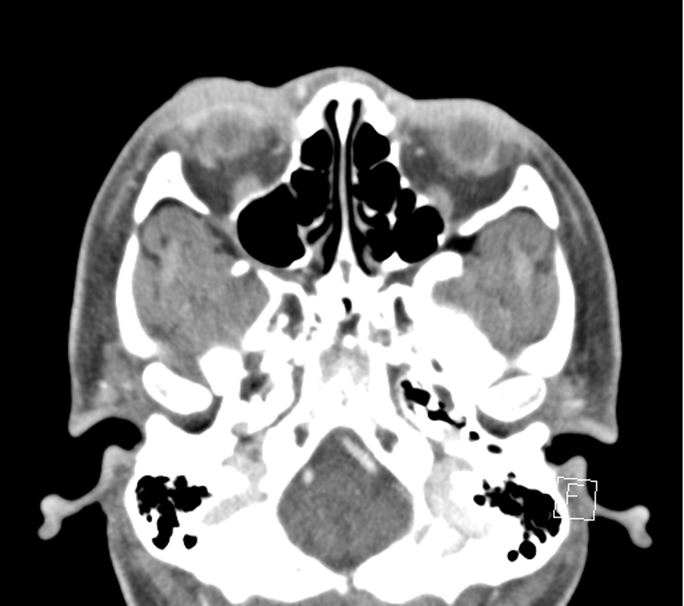 Gonococcal Preseptal Cellulitis, Gonococcal Conjunctivitis