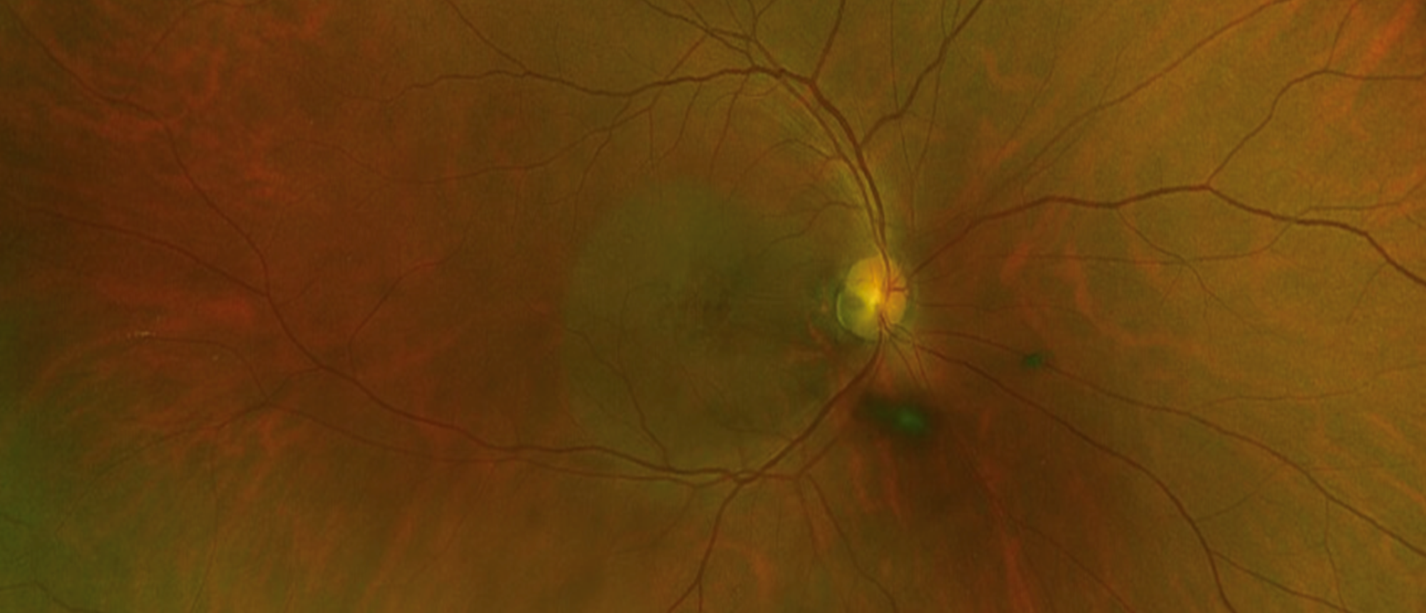 Optic Disc Pit Maculopathy