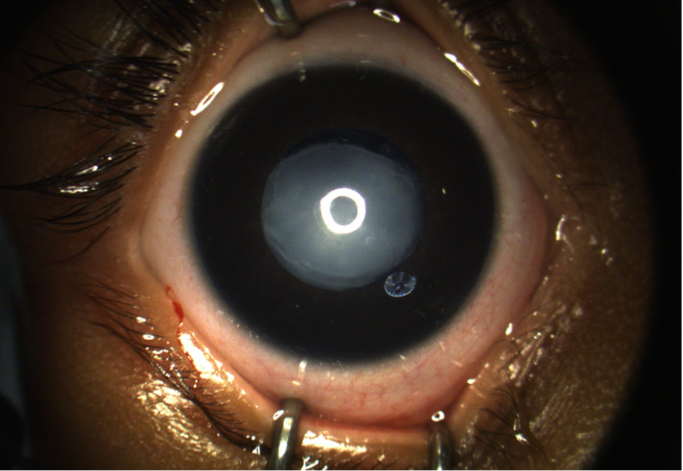 Proliferative Sickle Retinopathy