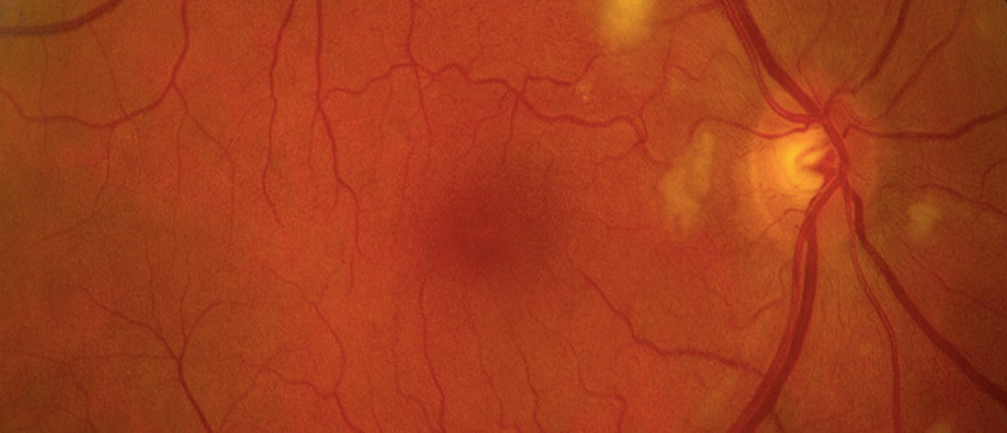 Chemotherapy (Gemcitabine) Induced Purtschers Like Retinopathy 