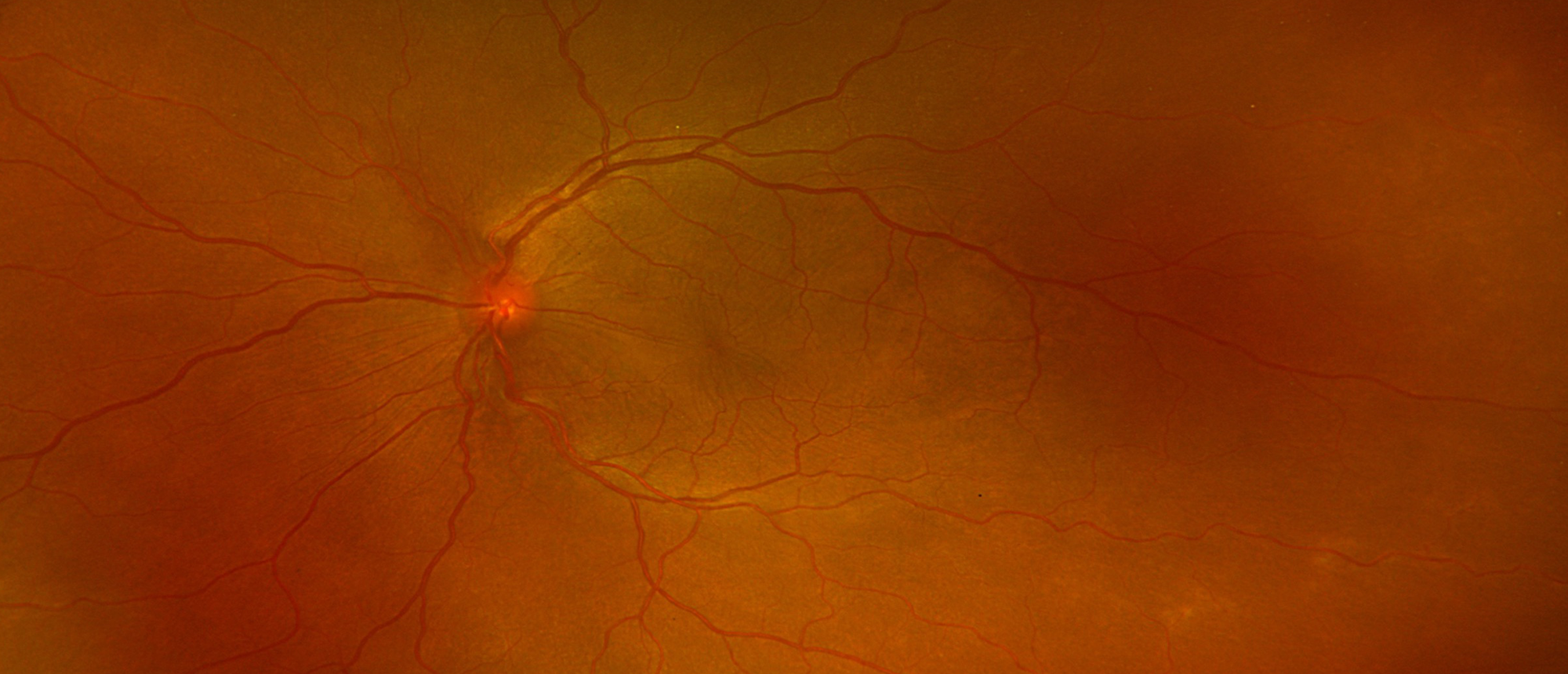Sympathetic Ophthalmitis