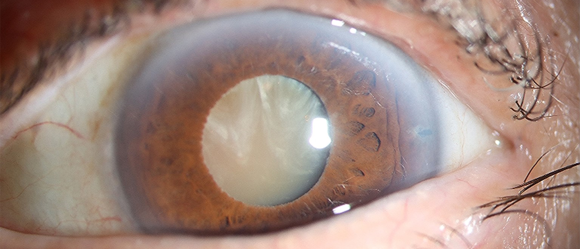 Morgagnian Cataract, Pseudoexfolation Syndrome, Phacolytic Glaucoma