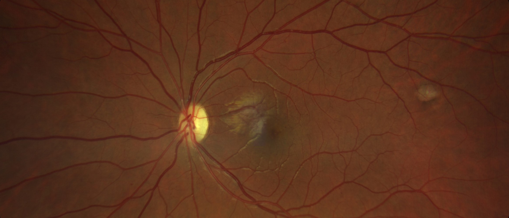 Wolfram Syndrome Type 1
