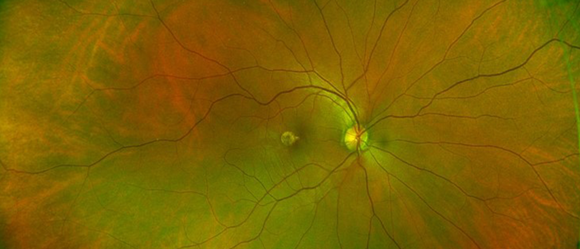 Macular Choroidal Neovascularization (CNV) Secondary to Punctate Inner Choroiditis