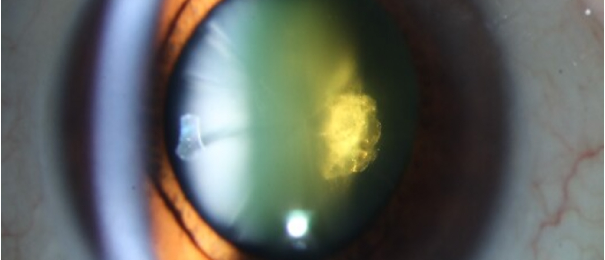 Posterior Capsule Rupture Following YAG Vitreolysis
