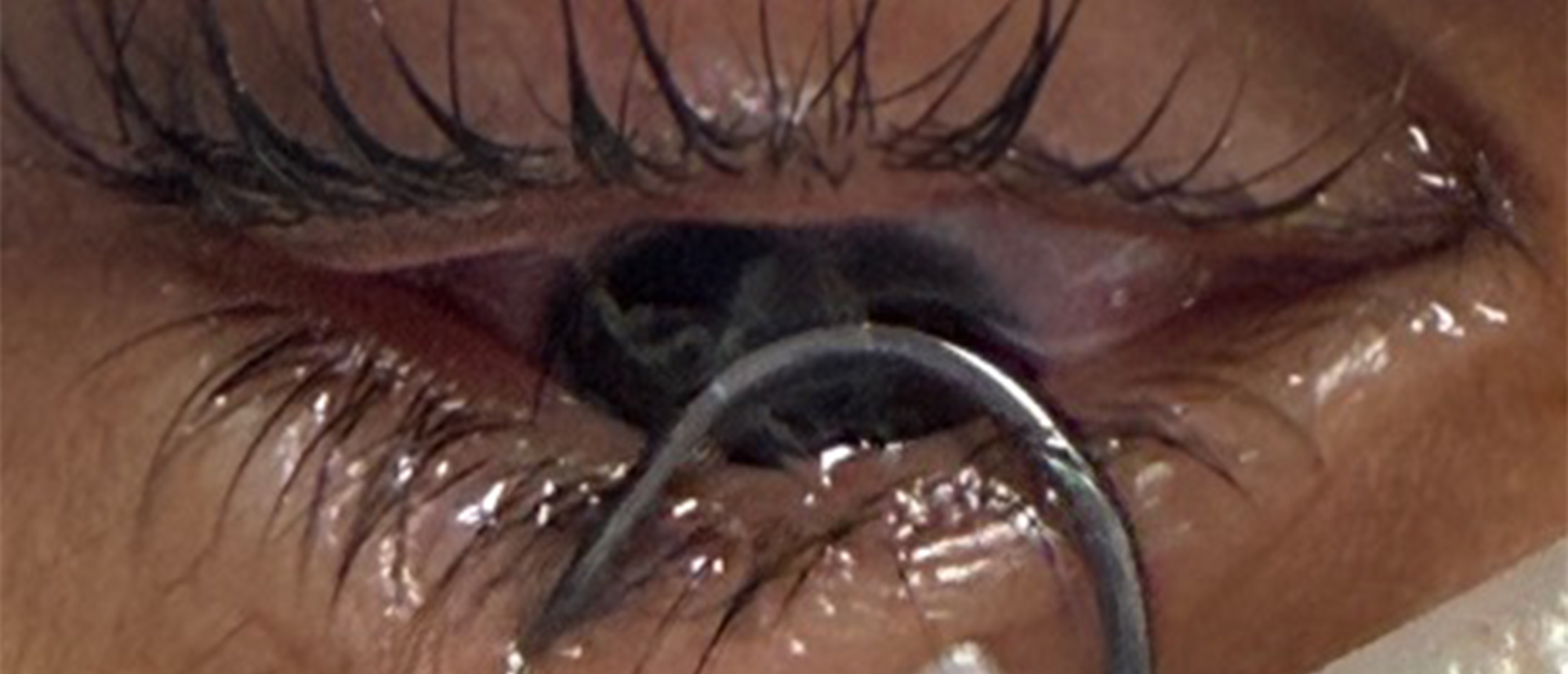 Lamellar Foreign Body, Fishhook Removal