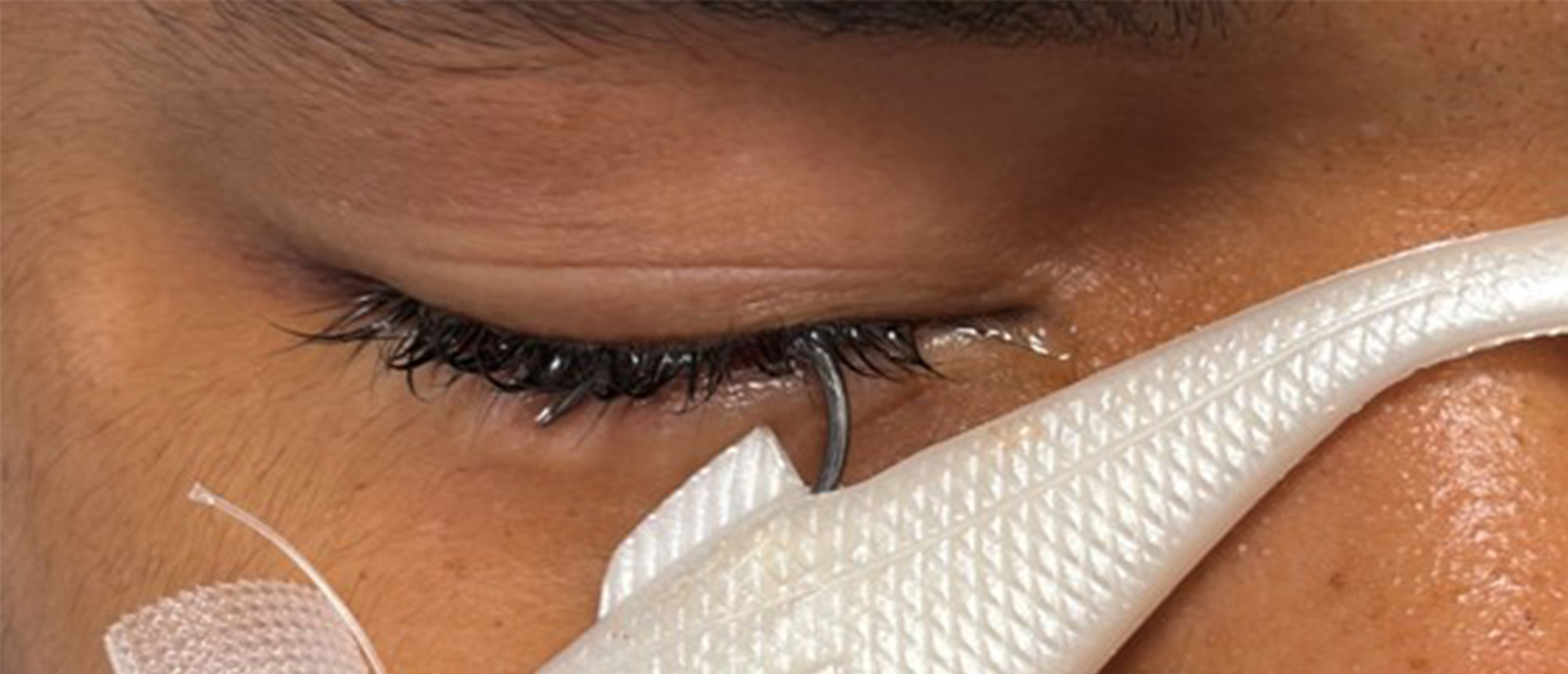 Intraocular Foreign Body