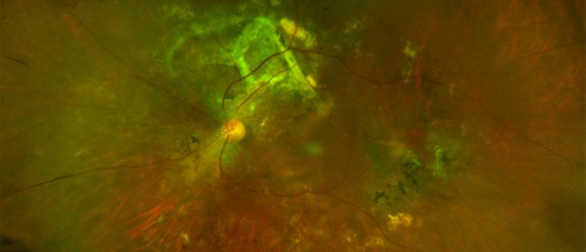 Polypoidal Choroidal Vasculopathy with Extramacular