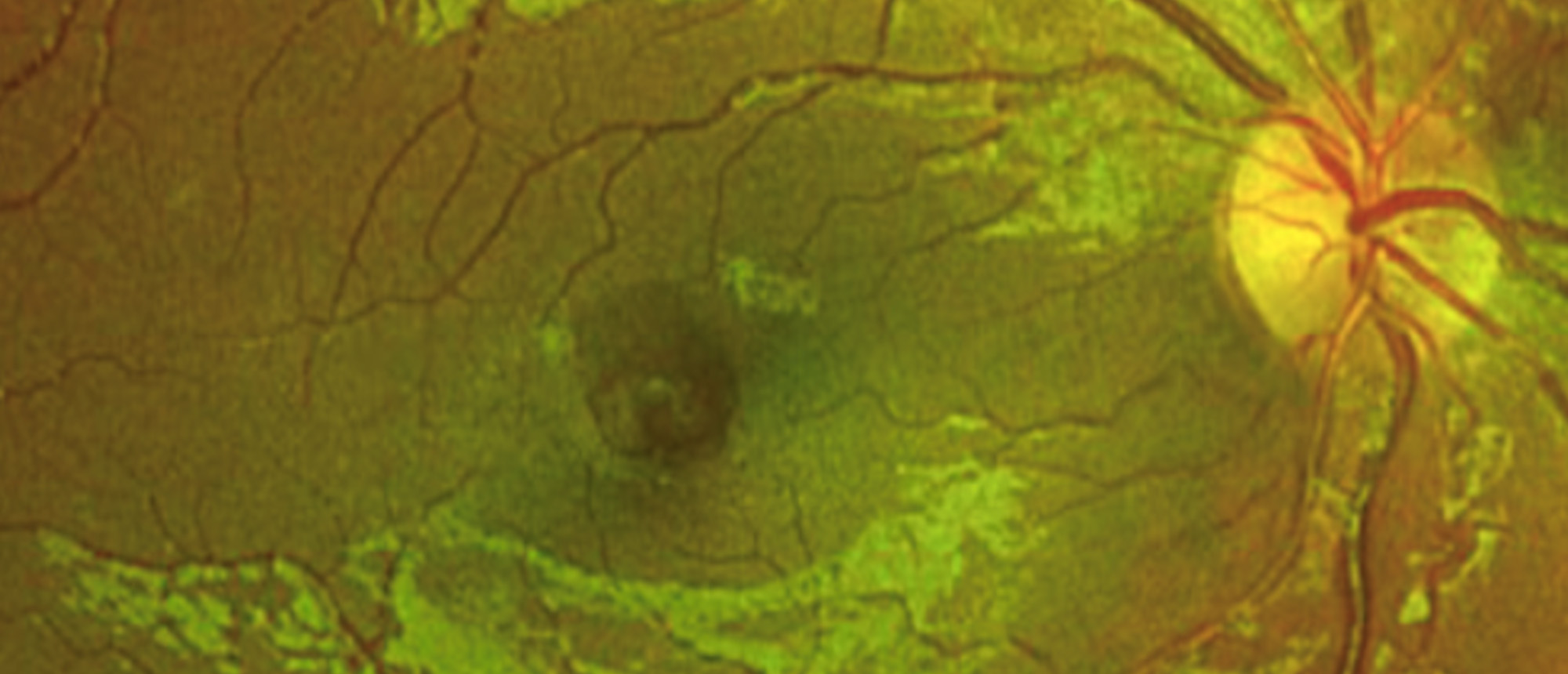 Laser Induced Retinopathy