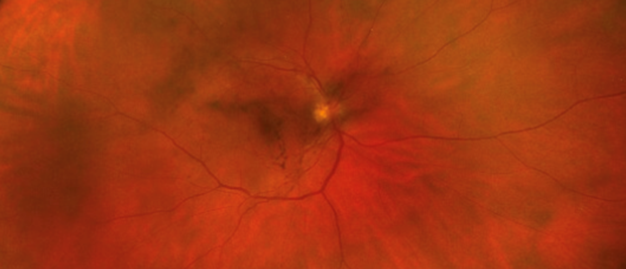 Ocular Involvement by Mycosis Fungoides / Cutaneous T Cell Lymphoma