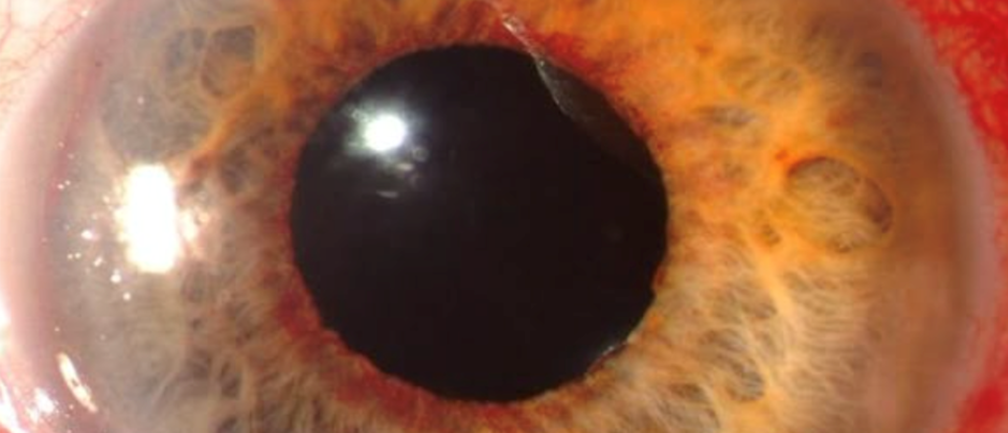 Neovascular Glaucoma