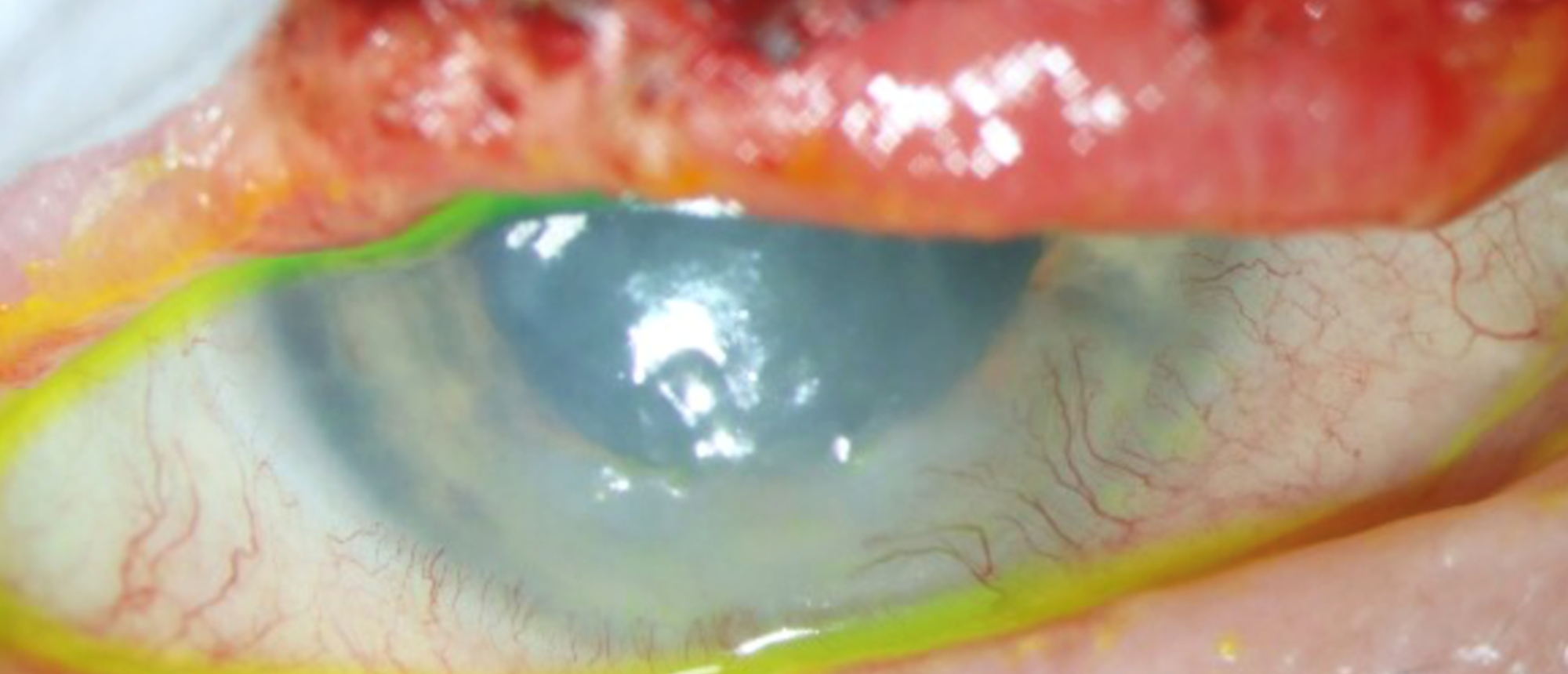 Herpes Zoster Optic Neuropathy