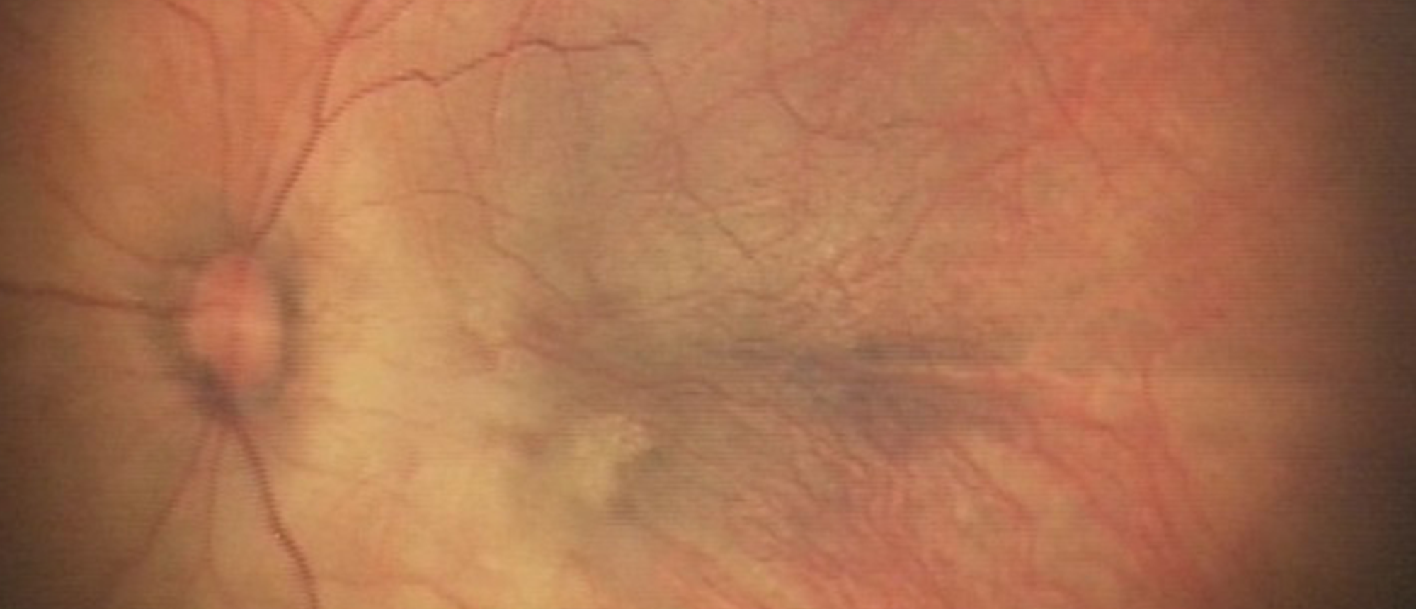Knobloch Syndrome 