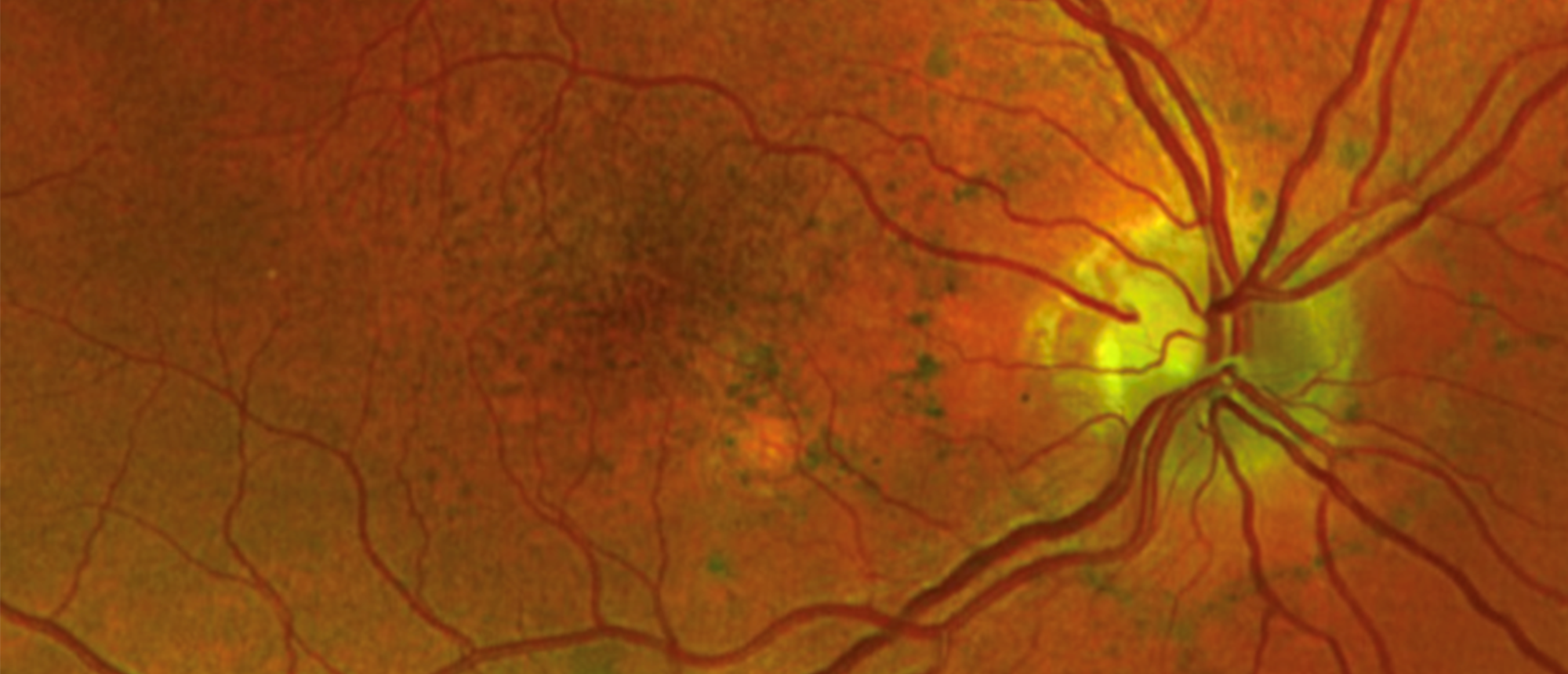Pattern Dystrophy of the Macula Associated with Maternally Inherited Diabetes and Deafness