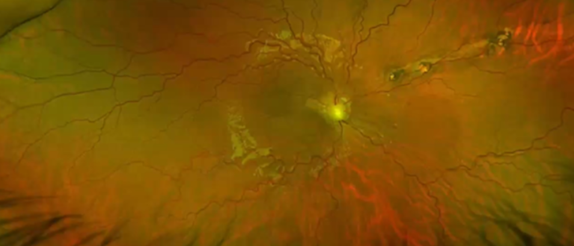 Papillorenal Syndrome 