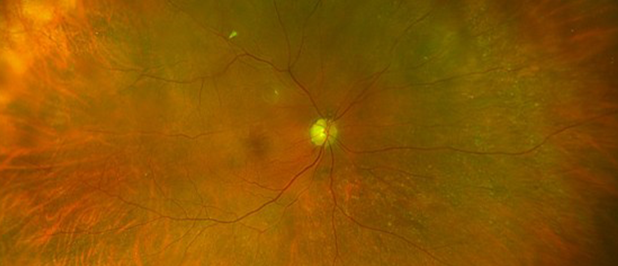 Choroidal Detachment