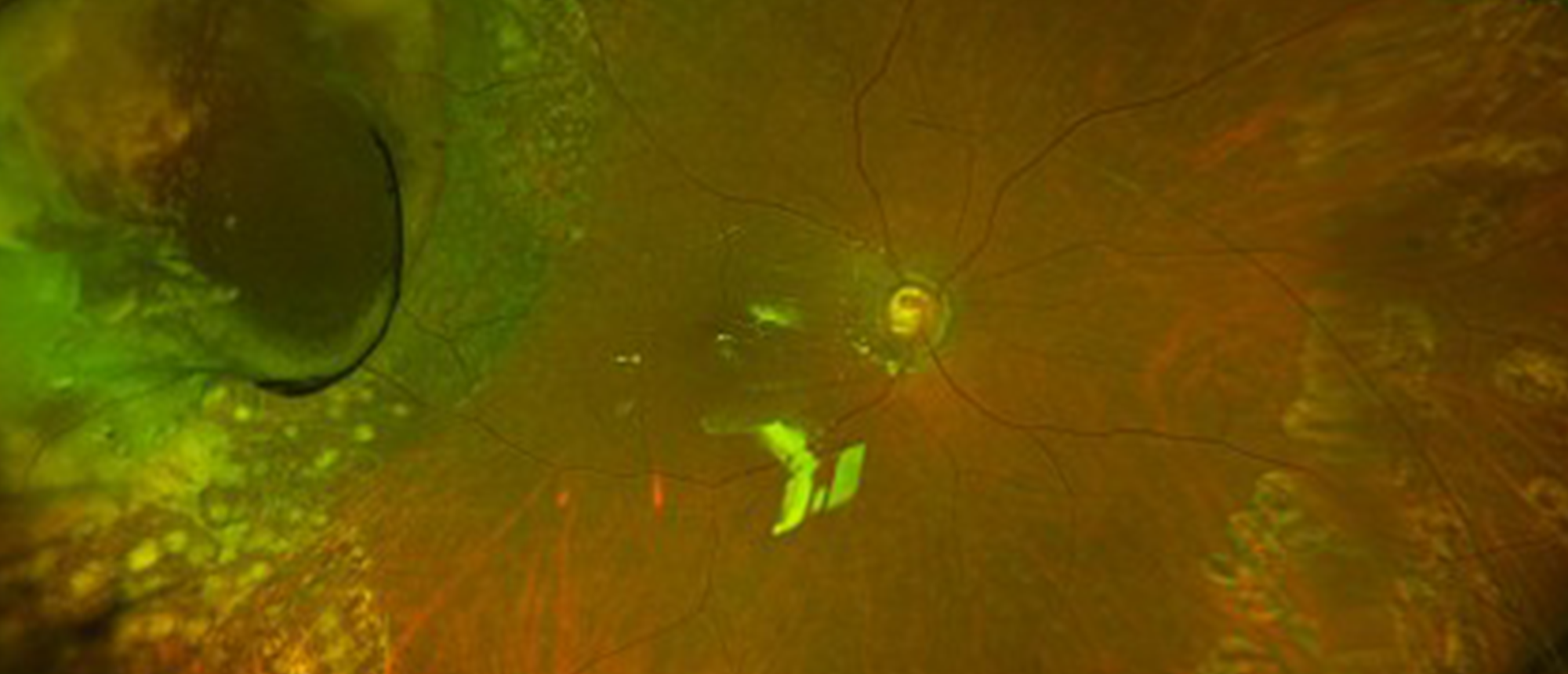 Choroidal Melanoma 