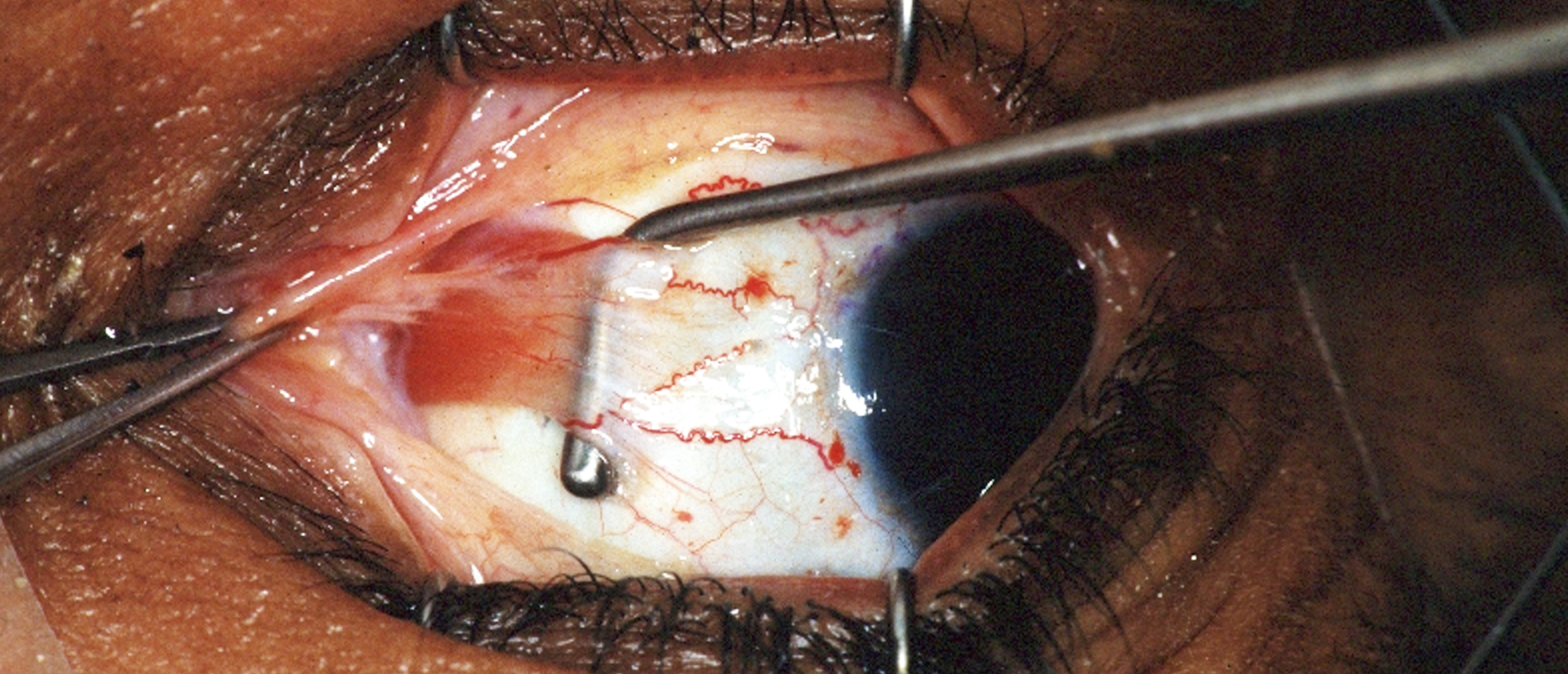 Idiopathic Intracranial Hypertension