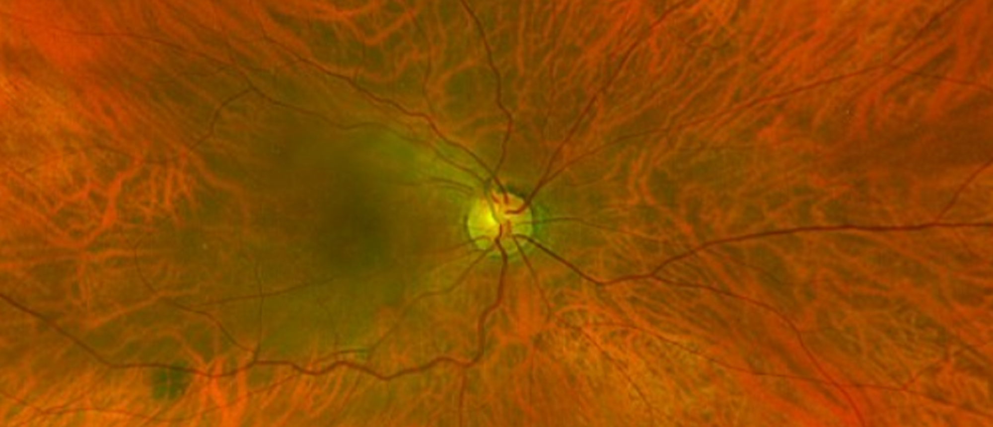 Optic Disc Pit Maculopathy