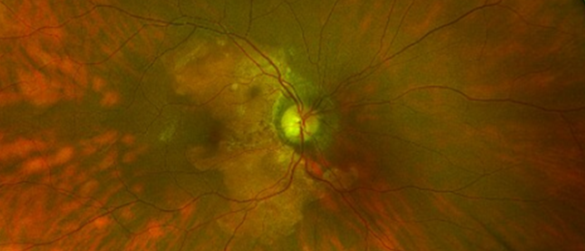 Rosai-Dorfman Disease