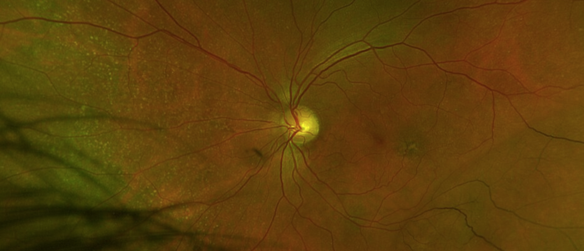 Retinoschisis
