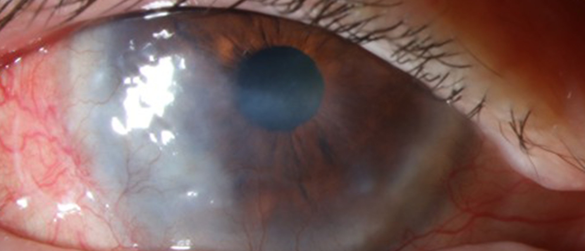 Interstitial Keratitis