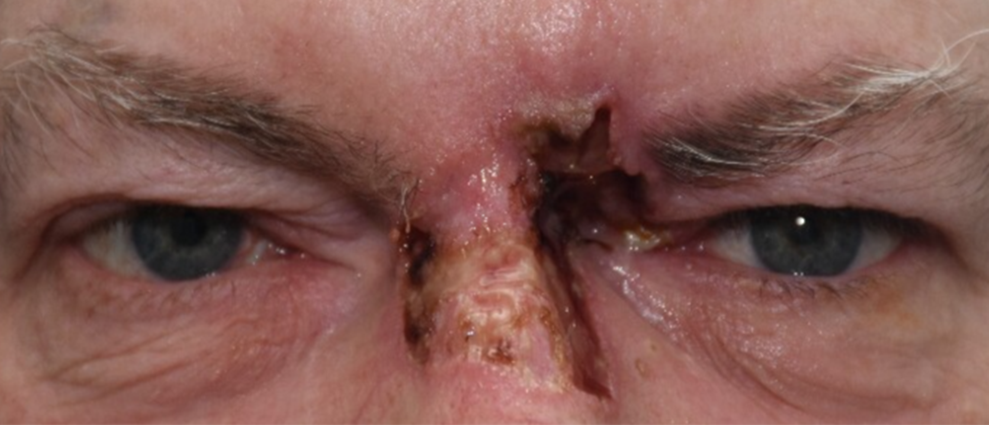 Choroidal Melanoma