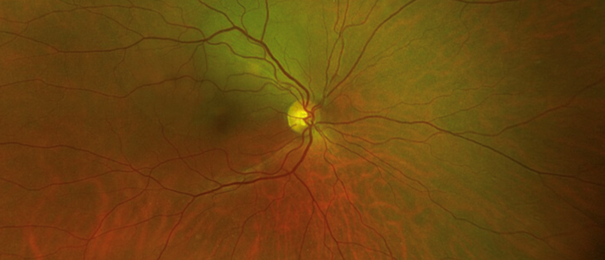 Choroidal Metastasis from Primary Lung Adenocarcinoma 